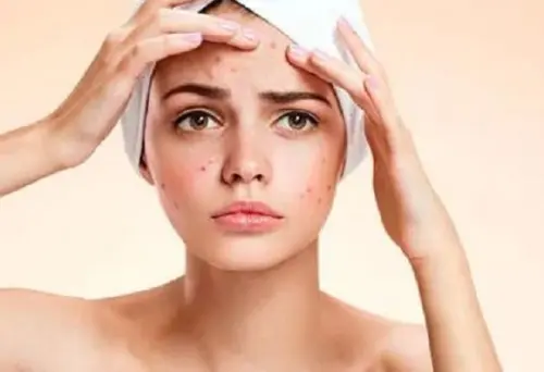 Consigli per liberarsi velocemente dai brufoli