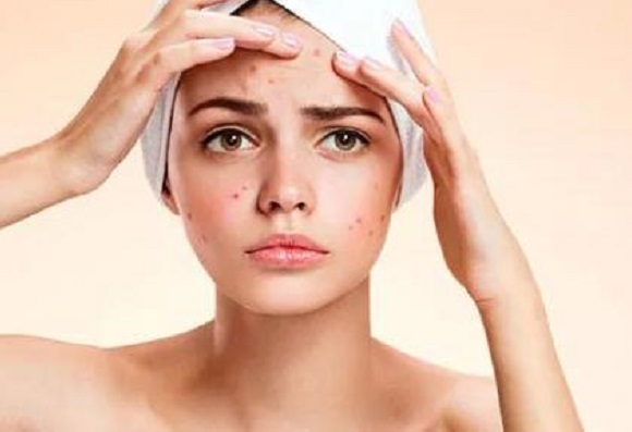 Consigli per liberarsi velocemente dai brufoli