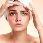 Consigli per liberarsi velocemente dai brufoli