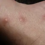 Verruche: come vengono, come curarle